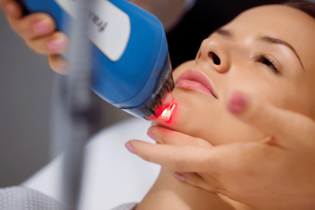 lasersko pomlajevanje kože obraza