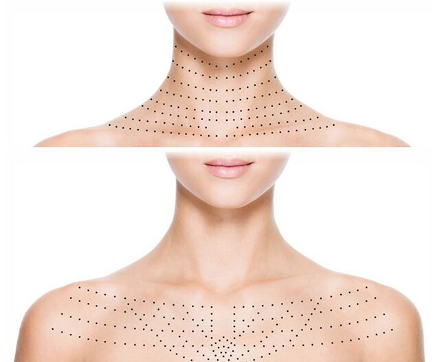 Oznake na koži vratu in dekolteja za pomlajevalno biorevitalizacijo
