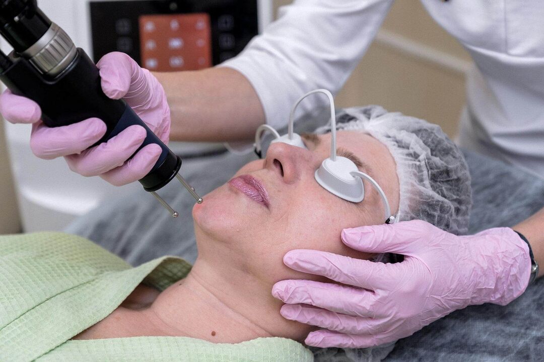 Ablativni laserski postopek pomlajevanja kože
