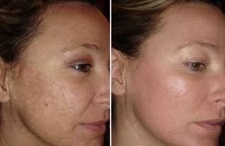 lasersko pomlajevanje obraza pred in po fotografijah